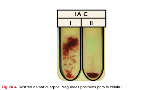 Figura 4. Rastreo de anticuerpos irregulares positivos para la célula 1