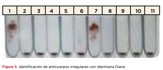 Figura 5. Identificación de anticuerpos irregulares con Identisera Diana