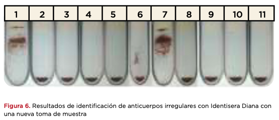 Figura 6. Resultados de identificación de anticuerpos irregulares con Identisera Diana con una nueva toma de muestra